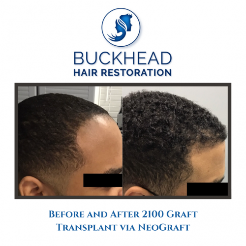 Before & After Hair Restoration with Neograft and PRP Therapy