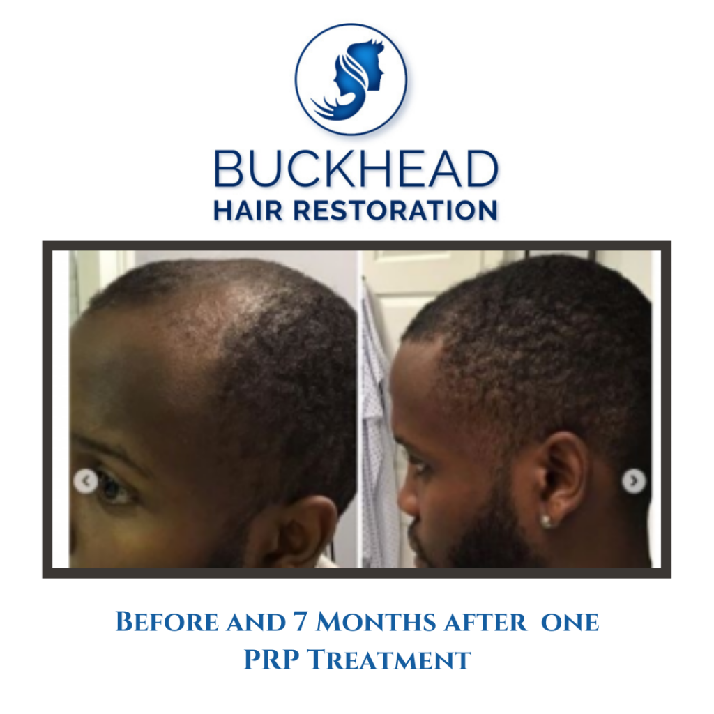 Before & After PRP Therapy Hair Restoration with Buckhead Hair Restoration
