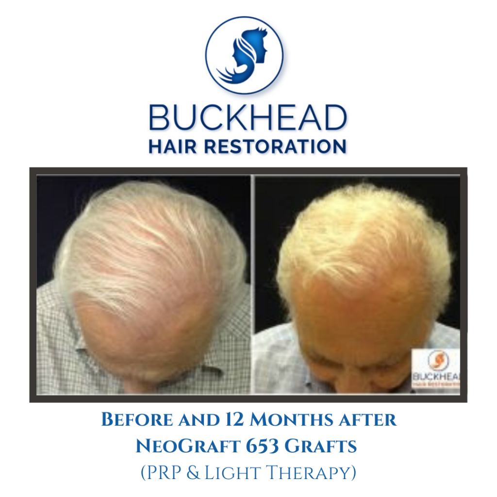 Before & After Hair Restoration with Buckhead Hair Restoration
