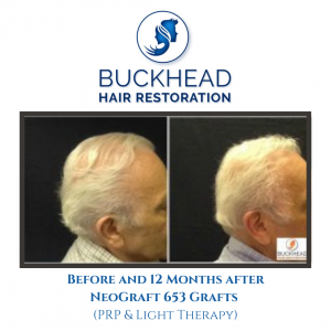 Before & After Hair Restoration with Buckhead Hair Restoration
