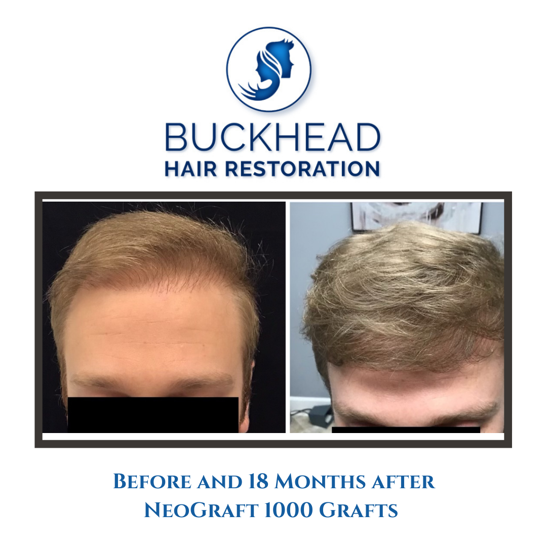 Before and 18 Months after NeoGraft 1000 Grafts