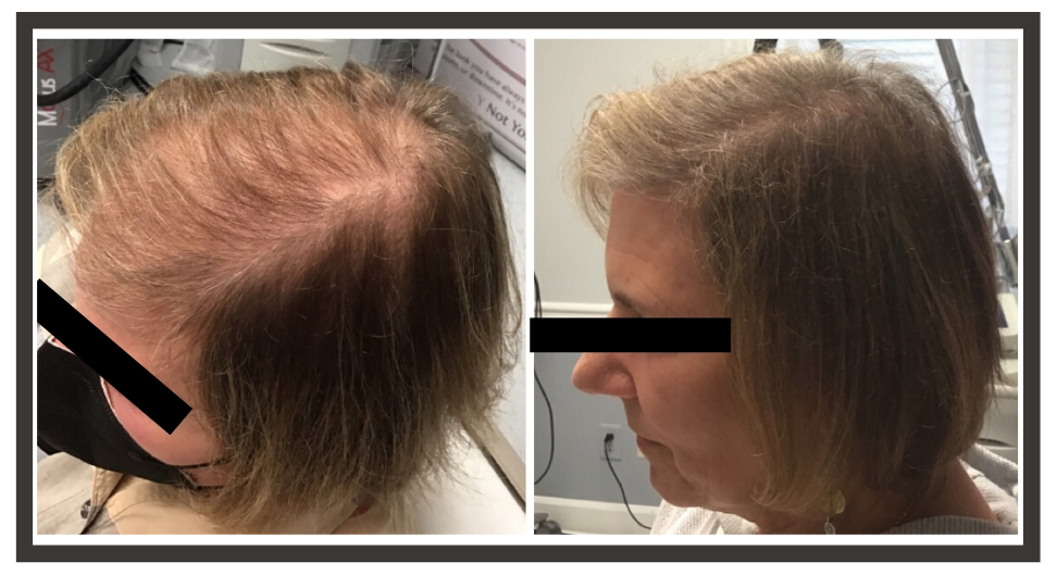 PRP Hair Loss Treatment - Transitions of Indiana