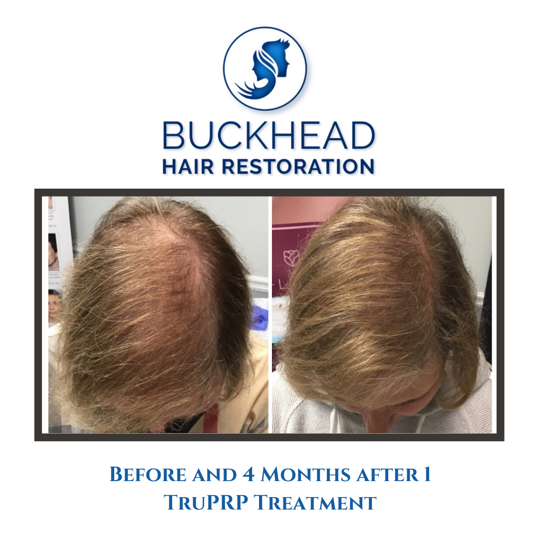 Before and after PRP Hair Restoration