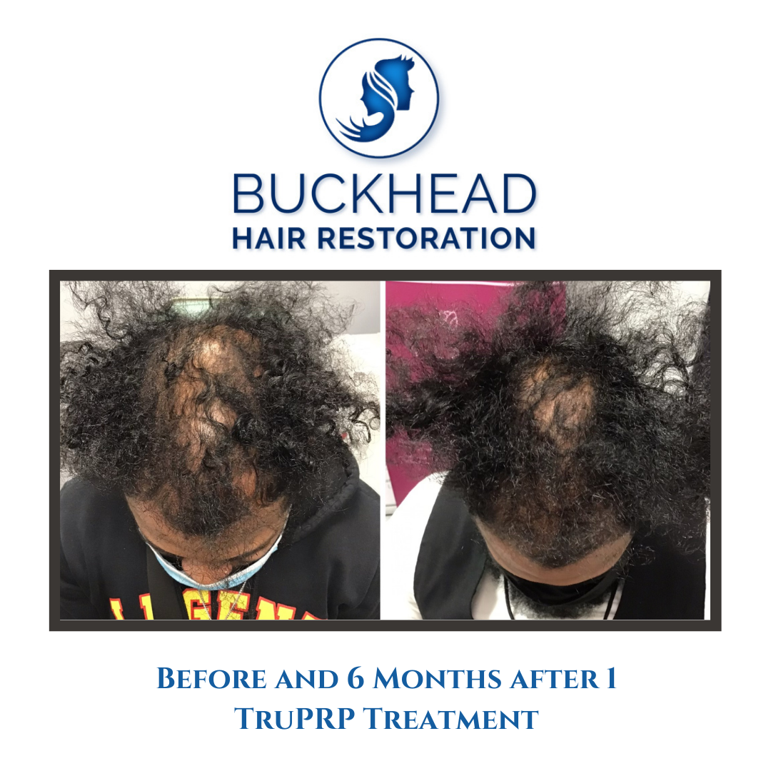 Before-and-6-Months-after-1-TruPRP-Treatment for hair loss in Atlanta and Warner Robins 