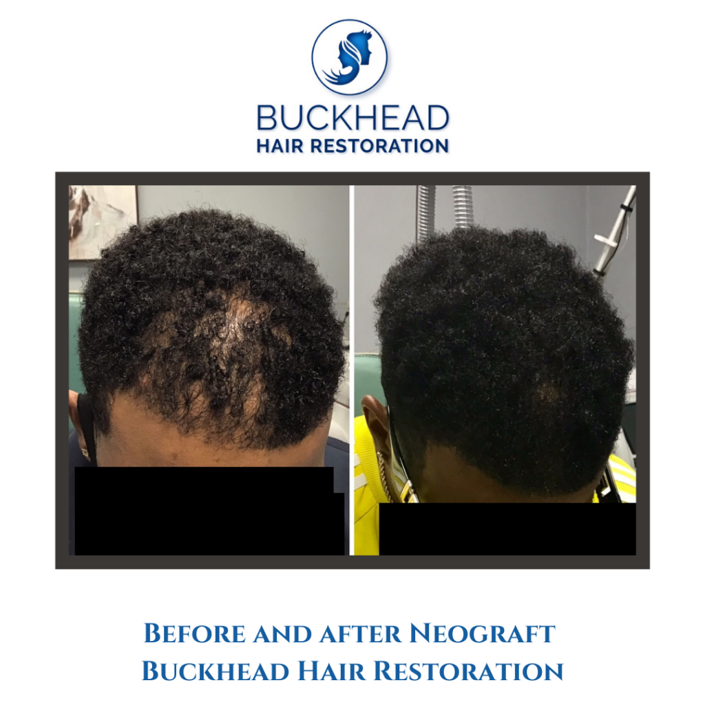 Before and After NeoGraft Hair Transplant with Buckhead Hair Restoration