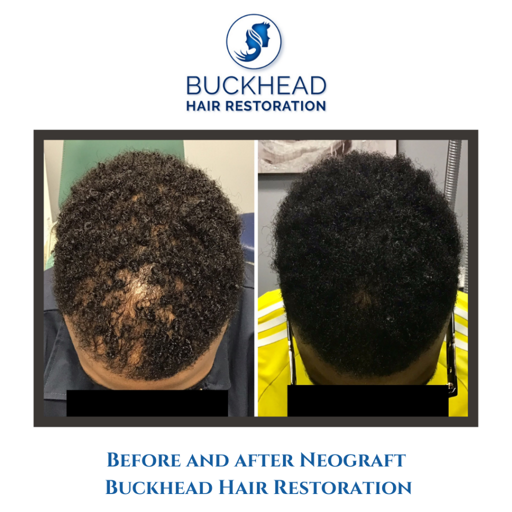 Before and After NeoGraft Hair Transplant with Buckhead Hair Restoration