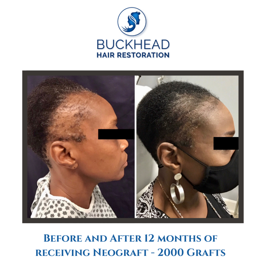 Before and after Neograft - Gallery - side view of American woman with traction alopecia