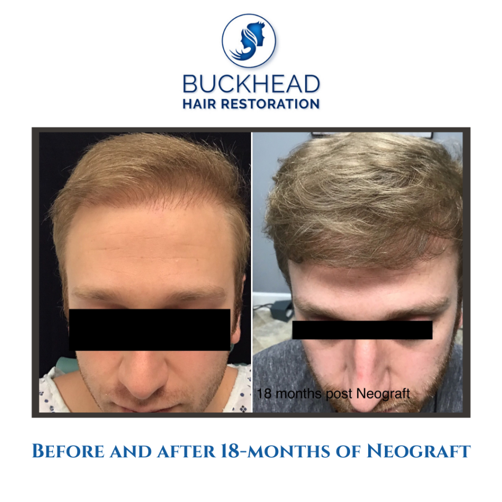 Front view Before and 18 Months After NeoGraft Hair Transplant with Buckhead Hair Restoration