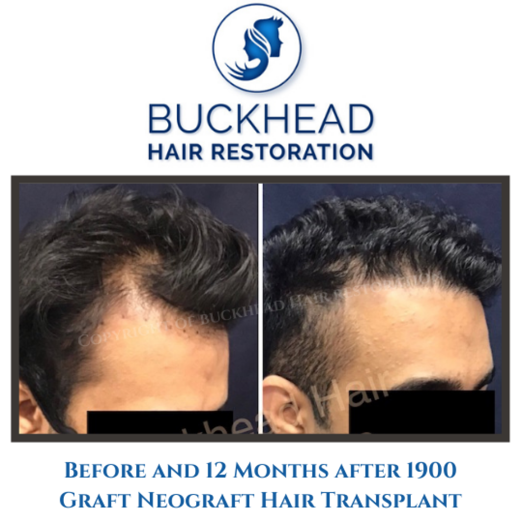 Before and 12 Months after 1900 Graft Neograft Hair Transplant