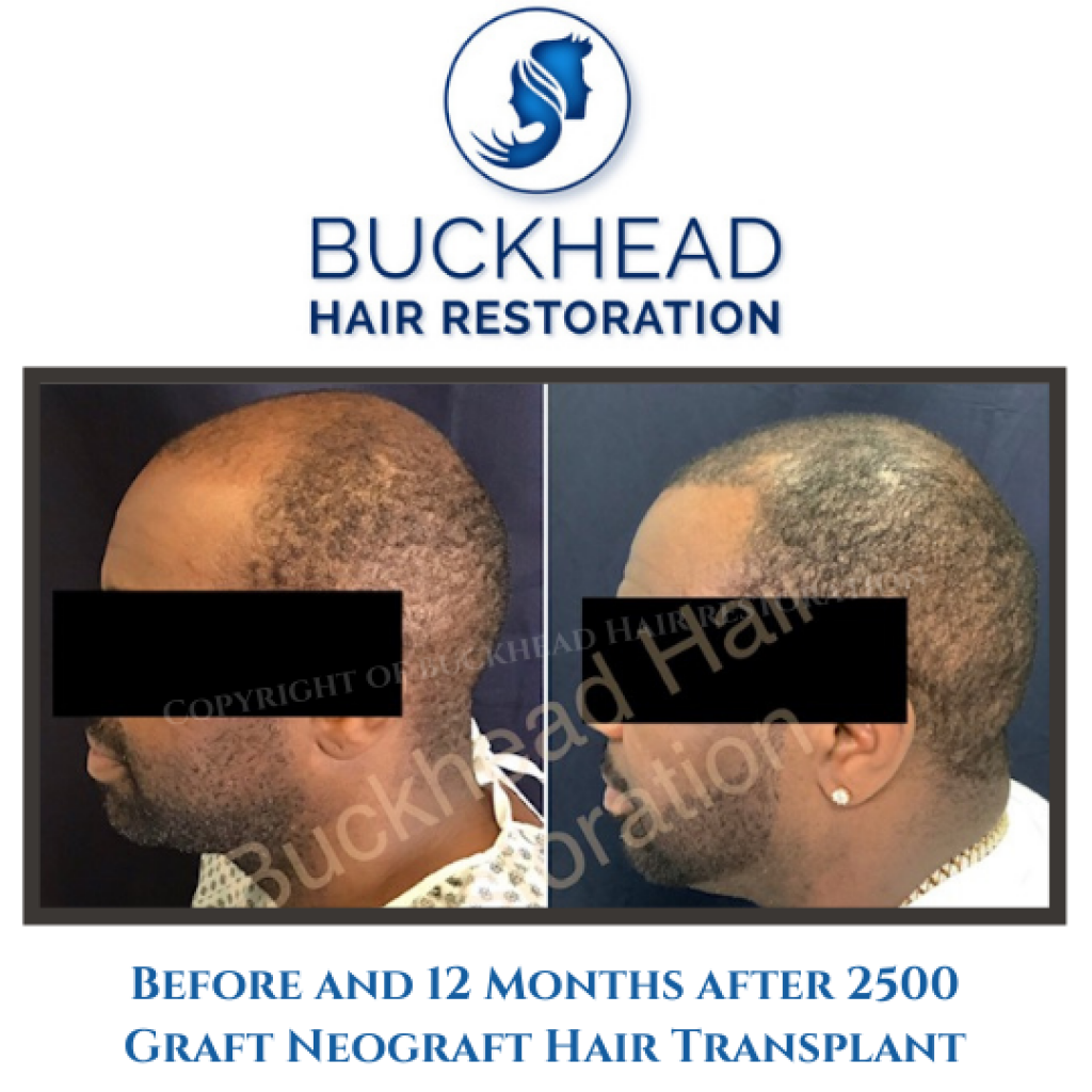 Before and 12 Months after 2500 Graft Neograft Hair Transplant
