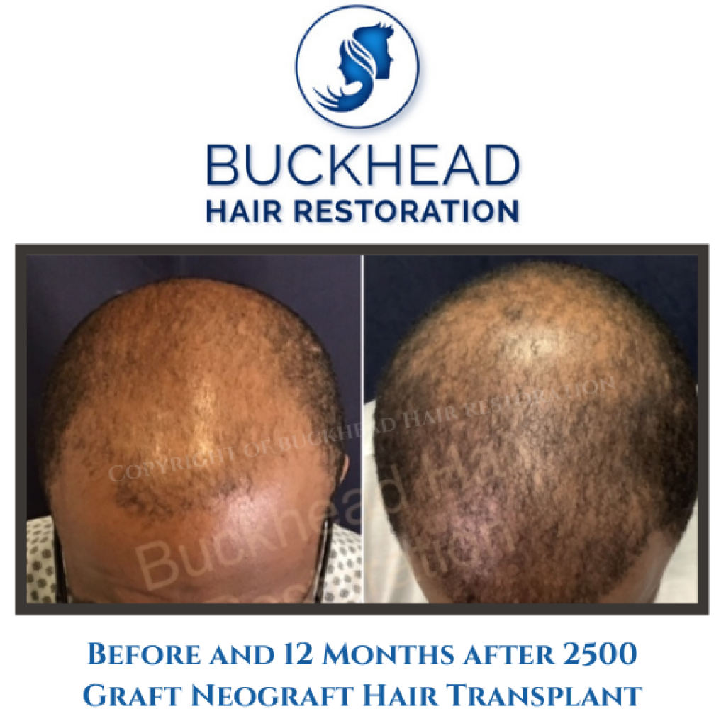 Before and 12 Months after 2500 Graft Neograft Hair Transplant