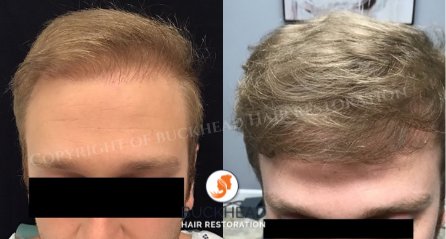 Before and 18 Months after NeoGraft 1000 Grafts - Buckhead Hair Restoration
