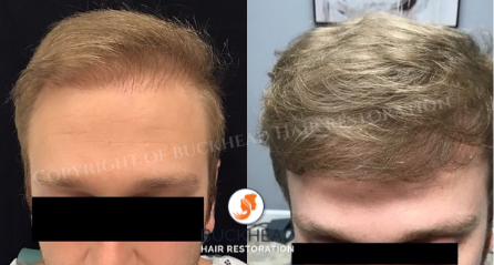 How Many Grafts Do I Need for Hair Transplant  Norwood Scale