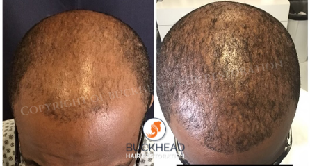 Before and 3 Months after NeoGraft 2000 Grafts- Buckhead Hair Restoration