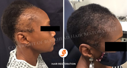 Before and 6 Months after NeoGraft 2000 Grafts- Buckhead Hair Restoration