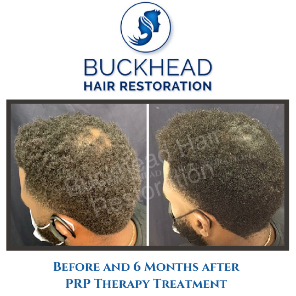 Before and 6 Months after PRP Therapy Treatment- Buckhead Hair Restoration Before and After (2)
