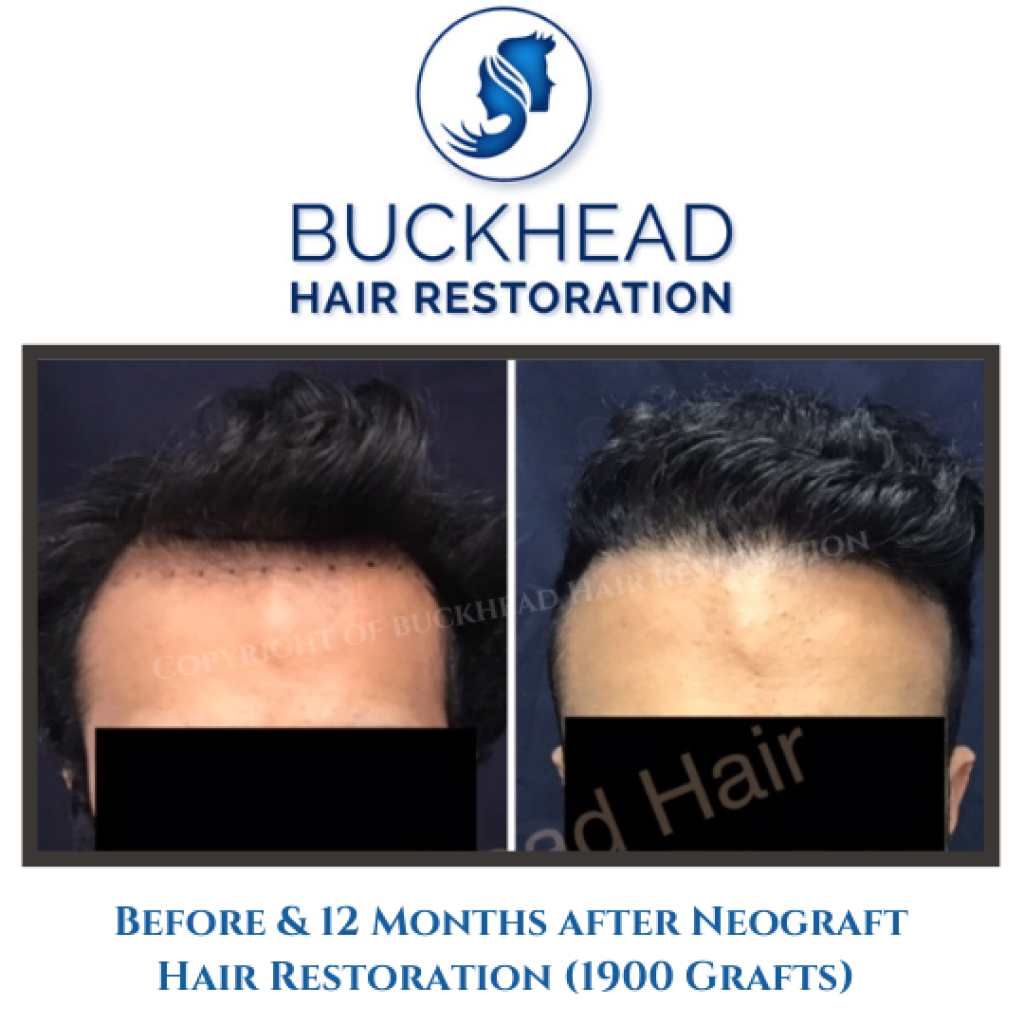 Before and after Hair Transplant by Dr. Monte Slater