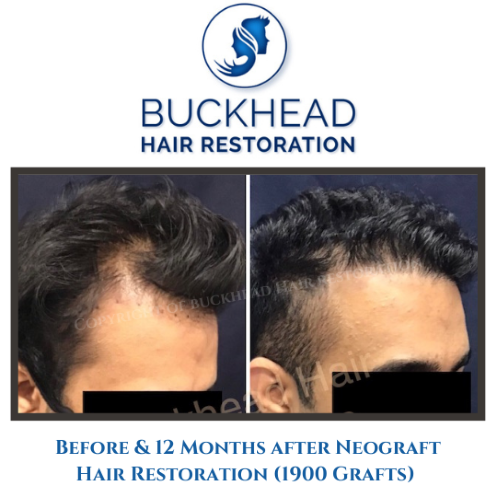 Before and after Hair Transplant by Dr. Monte S