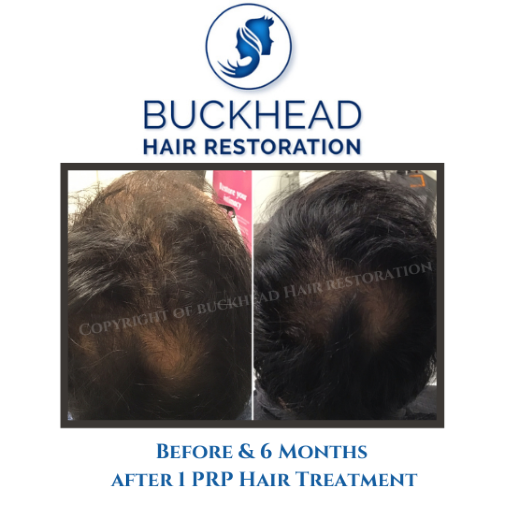 Before and after 6-month of receiving 1 PRP Hair Treatment at Buckhead Hair Restoration in Atlanta