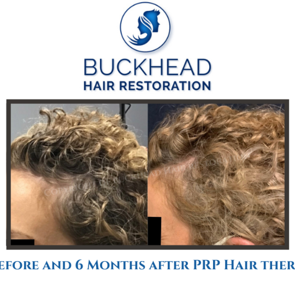Before and 6 Months after PRP Hair therapy (2)
