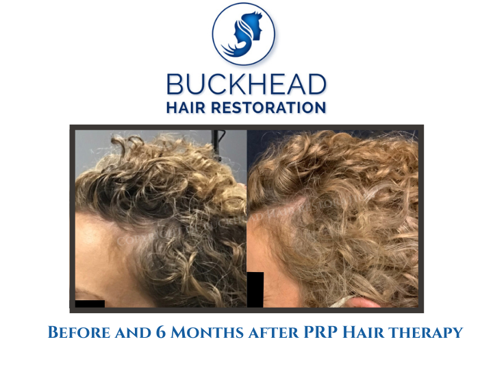 Before and 6 Months after PRP Hair therapy (2)