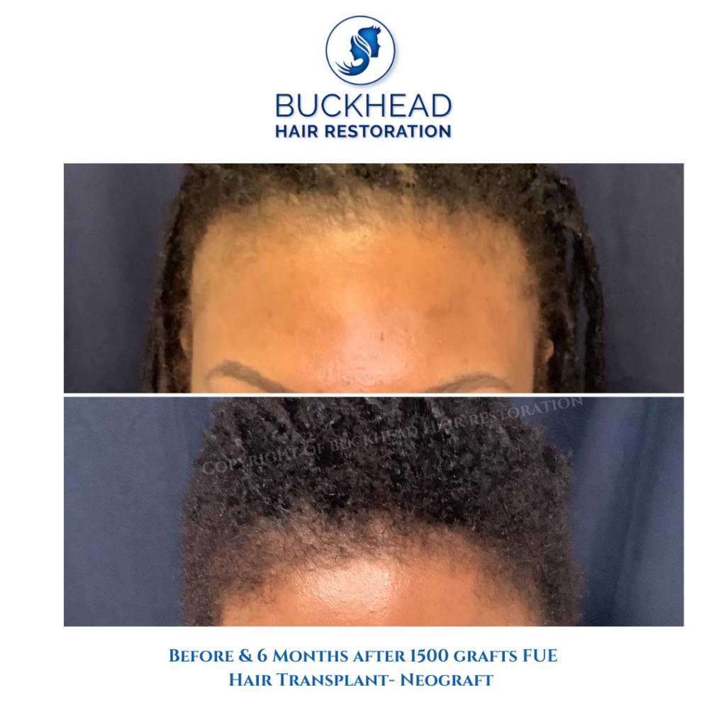 Before and after Neograft for traction alopecia Female Atlanta GA 2022