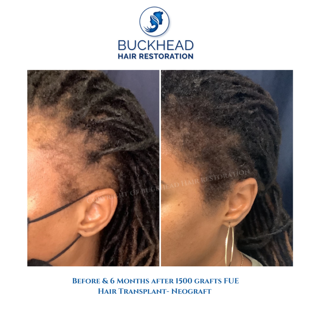 Before and after Hair restoration for traction alopecia - Female Hair Transplantation with Neograft Atlanta GA 2022