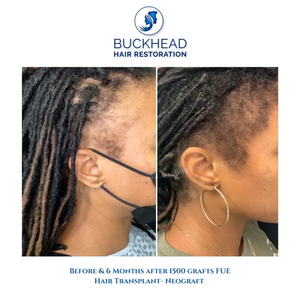 Before and after Hair restoration for traction alopecia - Female Hair Transplantation with Neograft Atlanta GA 2022