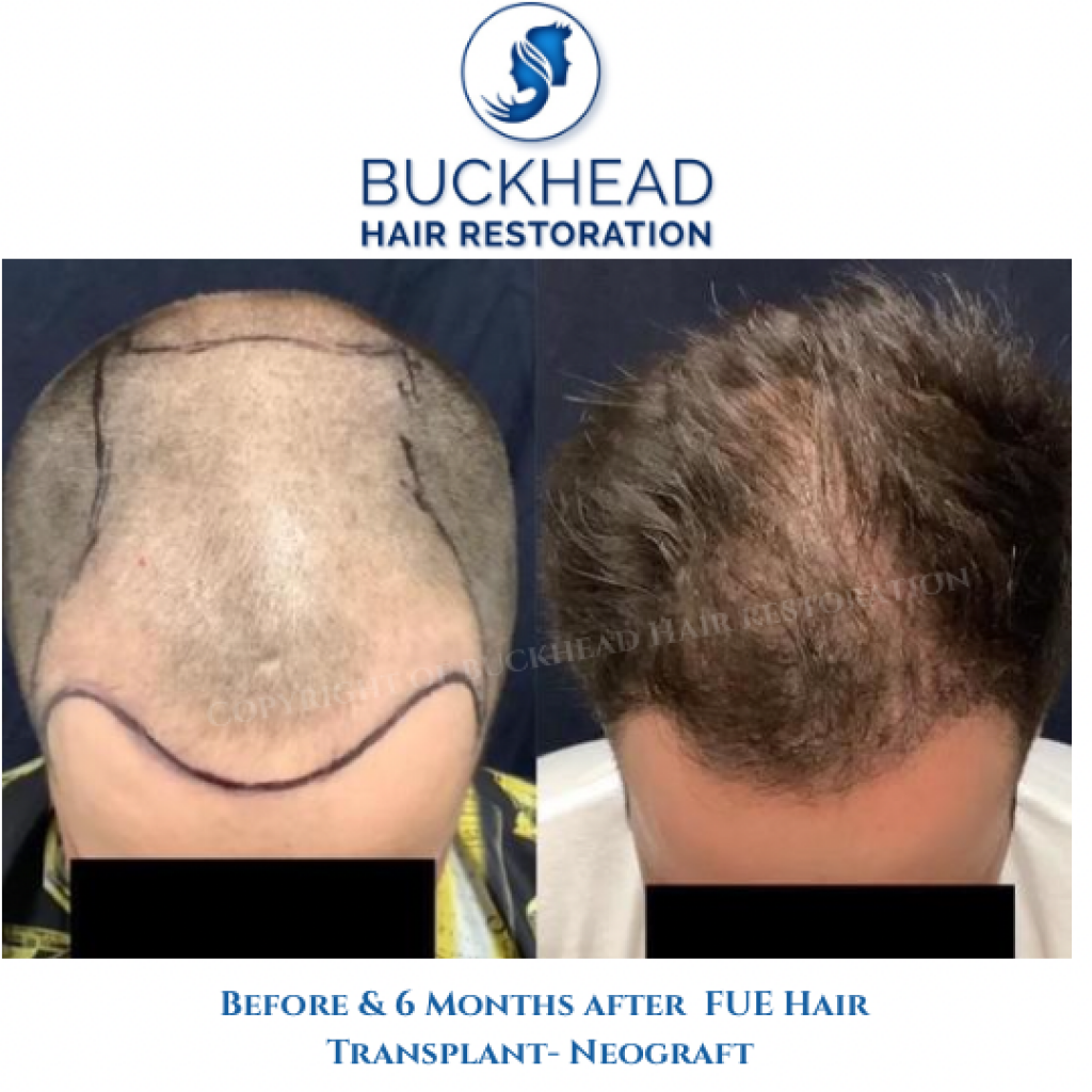 Front View Before and after 6-months of receiving Neograft Hair Transplant