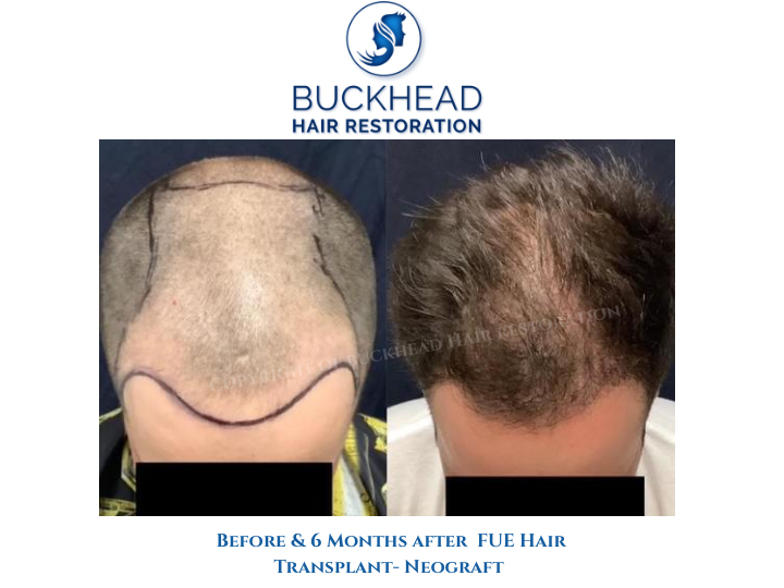 Front view before and after neograft Front View Before and after 6-months of receiving Neograft Hair Transplant