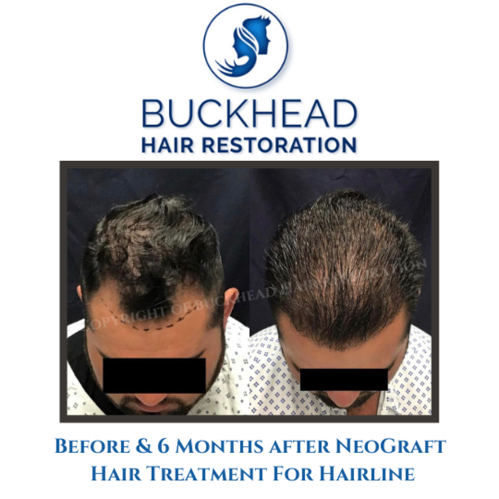 before-6-months-after-neograft-hair-treatment-for-hairline