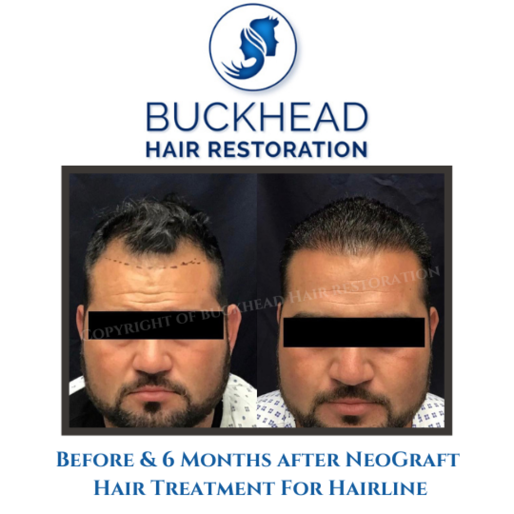 before-6-months-after-neograft-hair-treatment-for-hairline