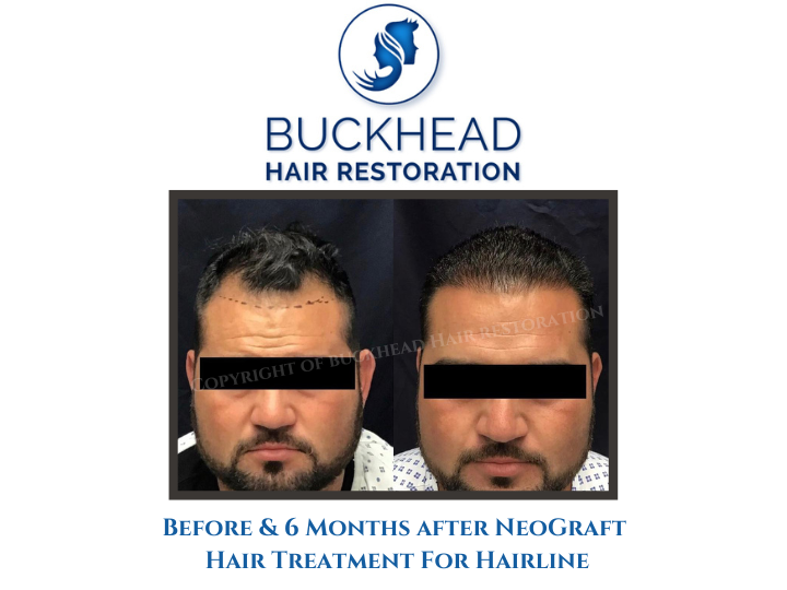 before-6-months-after-neograft-hair-treatment-for-hairline-2 before-6-months-after-neograft-hair-treatment-for-hairline