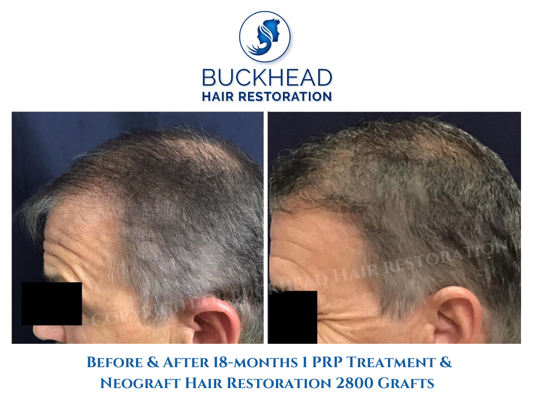before-and-after-18-months-of-receiving-1-prp-therapy-treatment-and-2800-grafts-with-neograft before-and-after-18-months-of-receiving-1-prp-therapy-treatment-and-2800-grafts-with-neograft