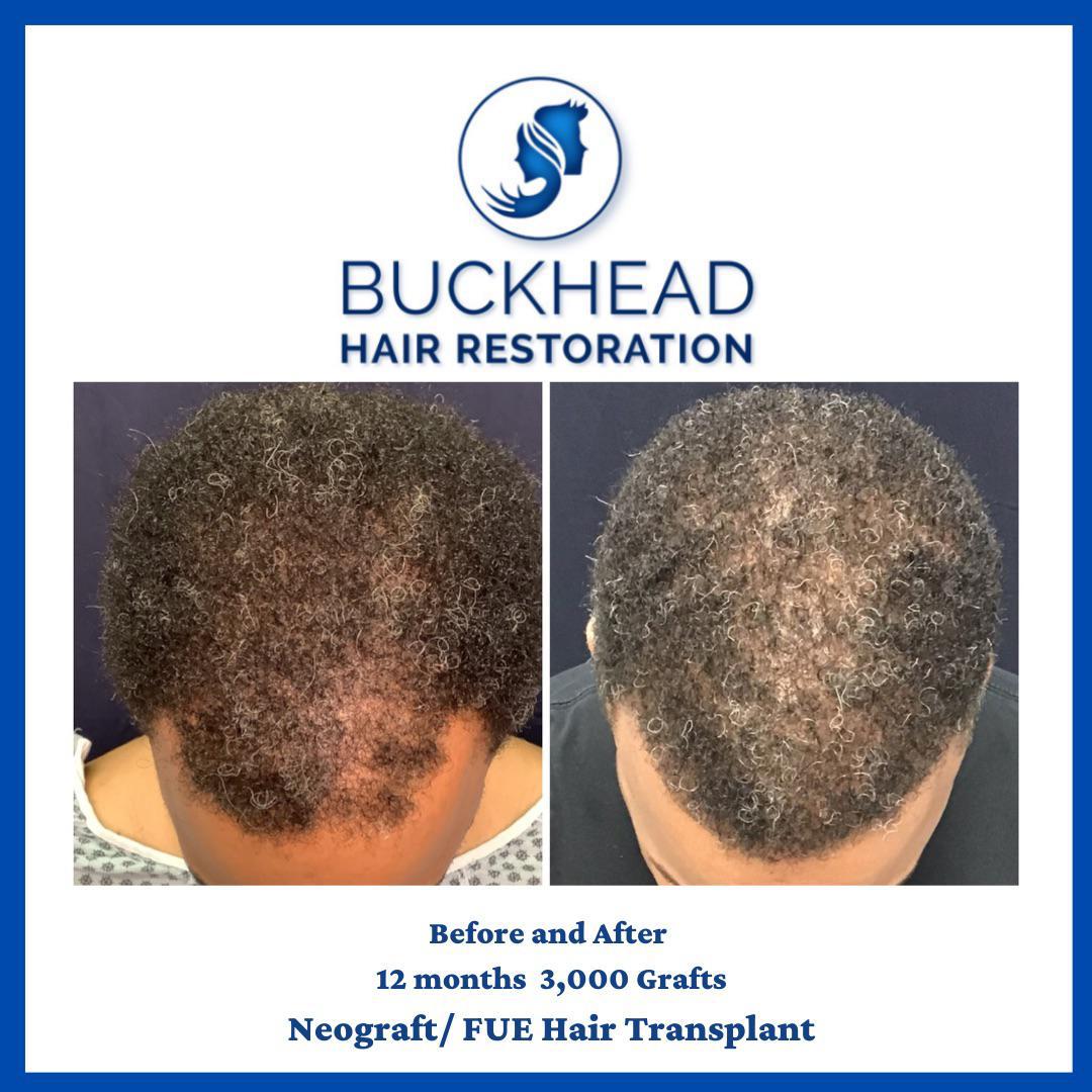 Before and After 12 Months 3,000 Grafts Neograft / FUE Hair Transplant Before and After 12 Months 3,000 Grafts Neograft / FUE Hair Transplant