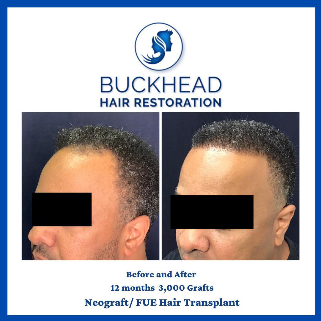 Before and After 12 Months 3,000 Grafts Neograft / FUE Hair Transplant Top Hair Restoration Techniques in 2025