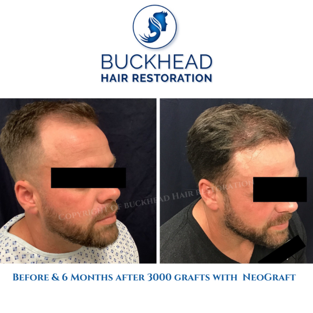 Before and after Neograft 3000 grafts