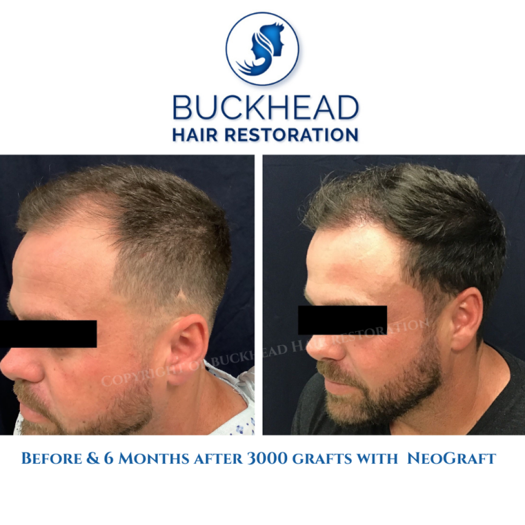 Before and after Neograft 3000 grafts at Buckhead Hair Restoration