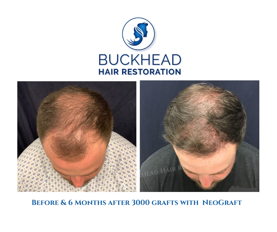 before-6-months-after-neograft-hair-treatment-for-hairline Before and after 3000 grafts