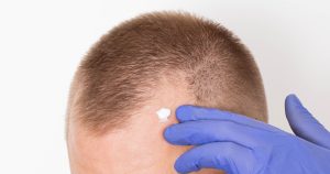 Best Non-Surgical Hair Restoration Treatments for Thinning Hair in Atlanta