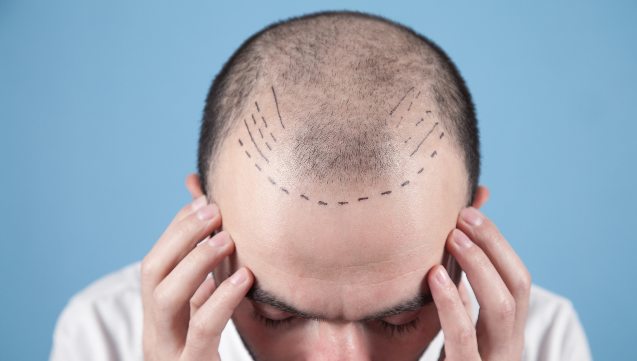 do-hair-transplants-hurt-1 Do Hair Transplants Hurt