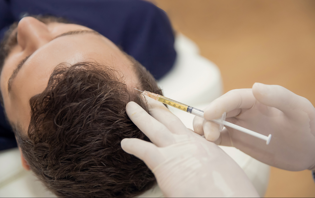 prp-hair-treatment-atlanta PRP hair treatment Atlanta