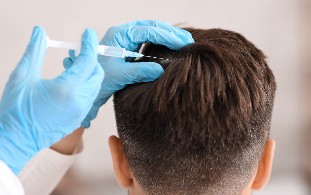 prp-hair-treatment-atlanta-3 PRP hair treatment for men Atlanta