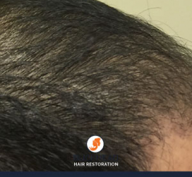 Natural Hair Restoration Results