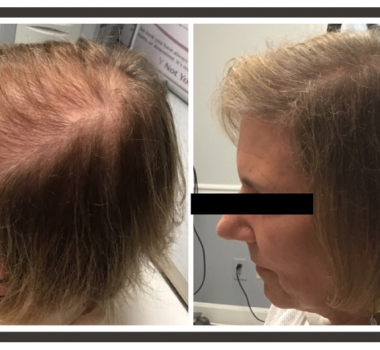 Nine Answers to Your Questions About PRP Therapy for Hair Loss