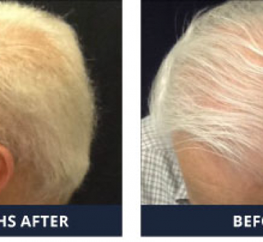 Male Pattern Baldness stops at  Buckhead Hair Restoration