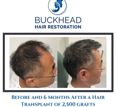 Natural Looking Hair Restoration at Buckhead’s #1 Hair Clinic
