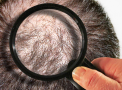 Seven Most Common Hair Loss Questions and Answers