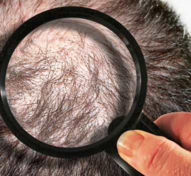 Seven Most Common Hair Loss Questions and Answers