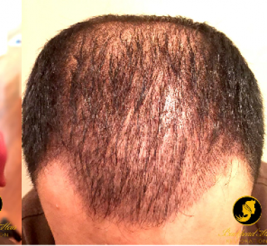 Oscar Hair And The Men who’ve Had NeoGraft Hair Restoration